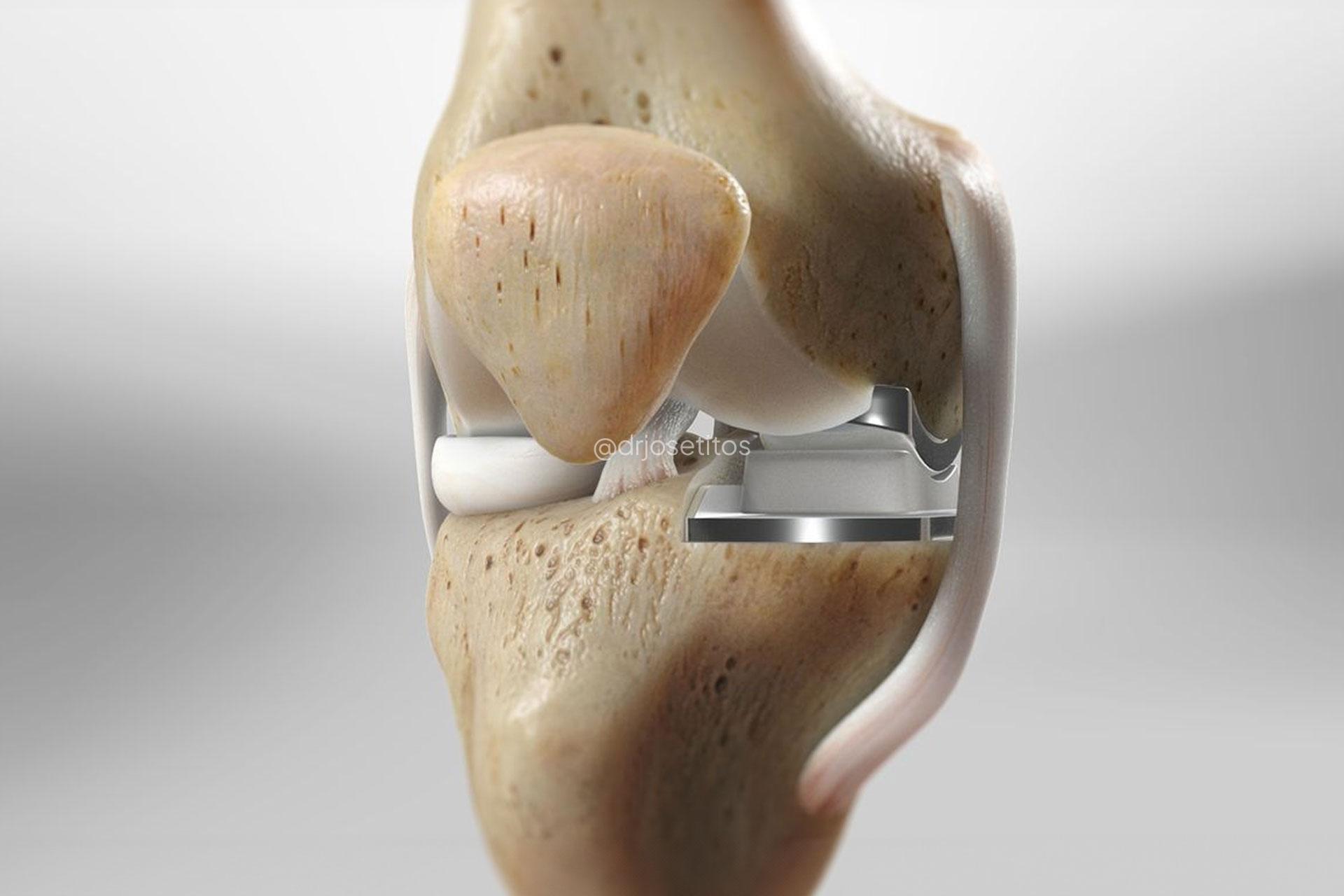 Protesis parcial de rodilla Protesis parcial de rodilla
