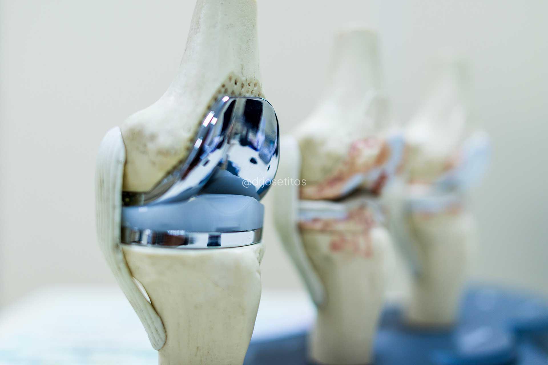 Prótesis total de rodilla Prótesis total de rodilla