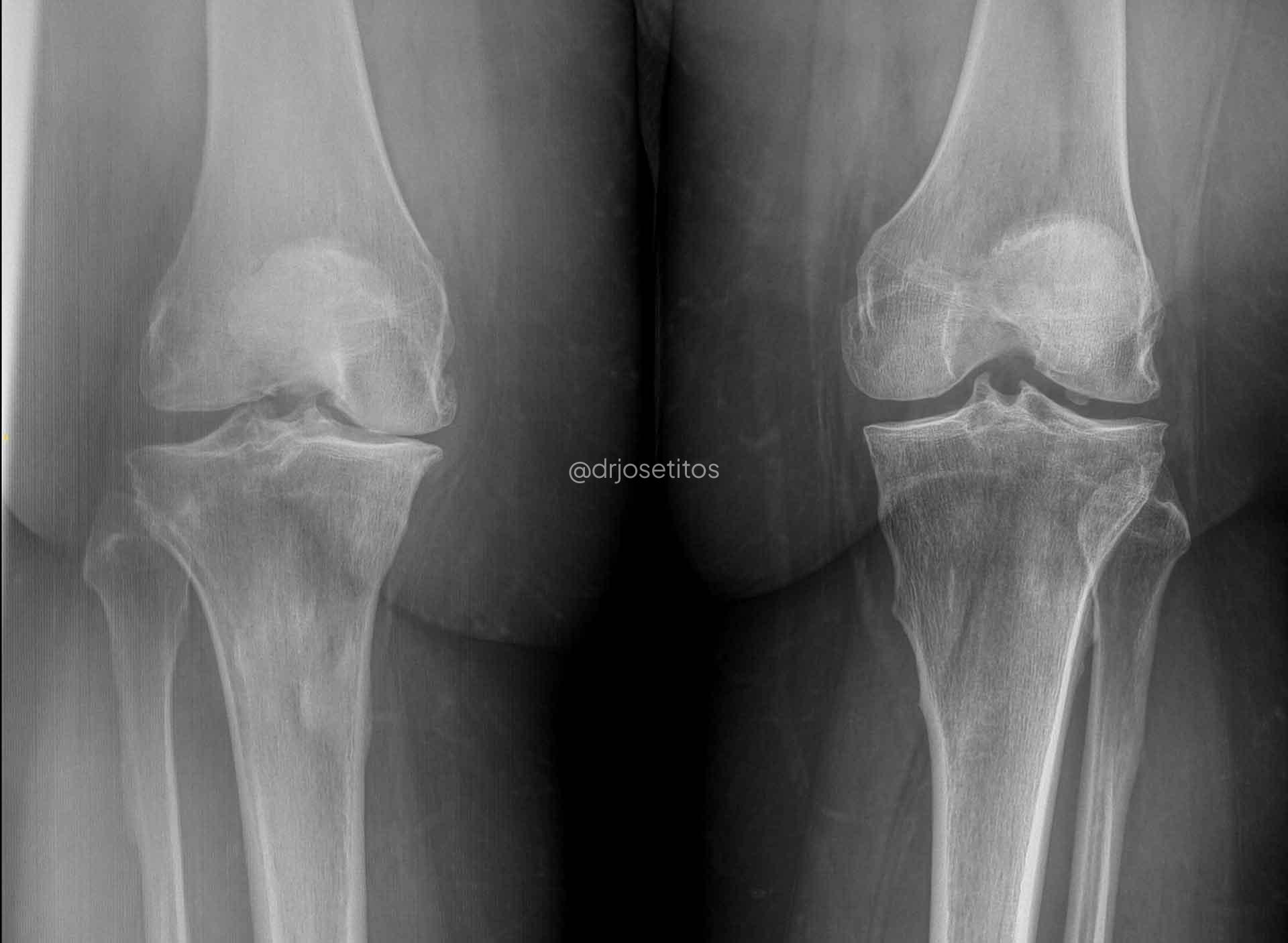 RX Artrosis de rodilla RX Artrosis de rodilla