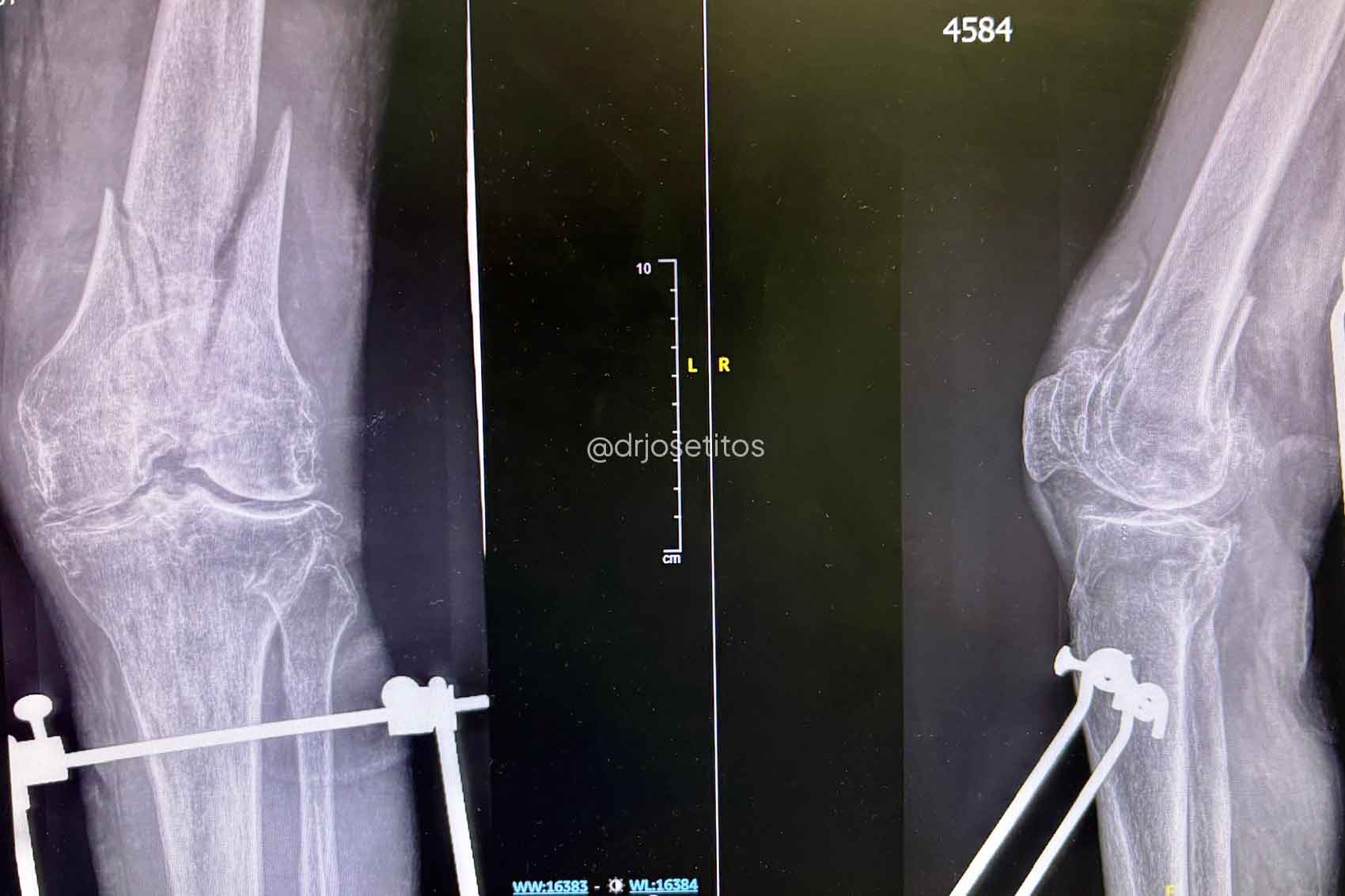 Trauma fémur distal