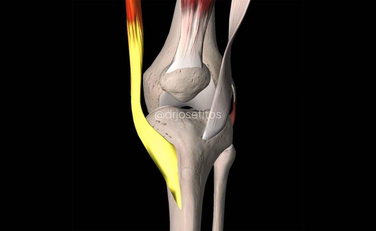Tendinitis Pata de Ganso