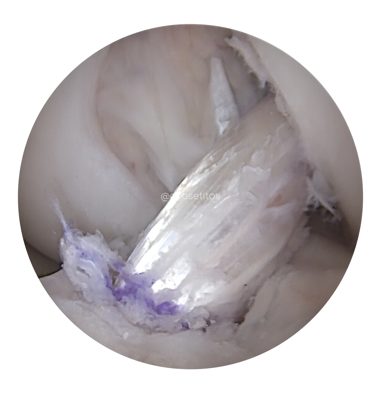 LCA-Plastia LCA-Plastia