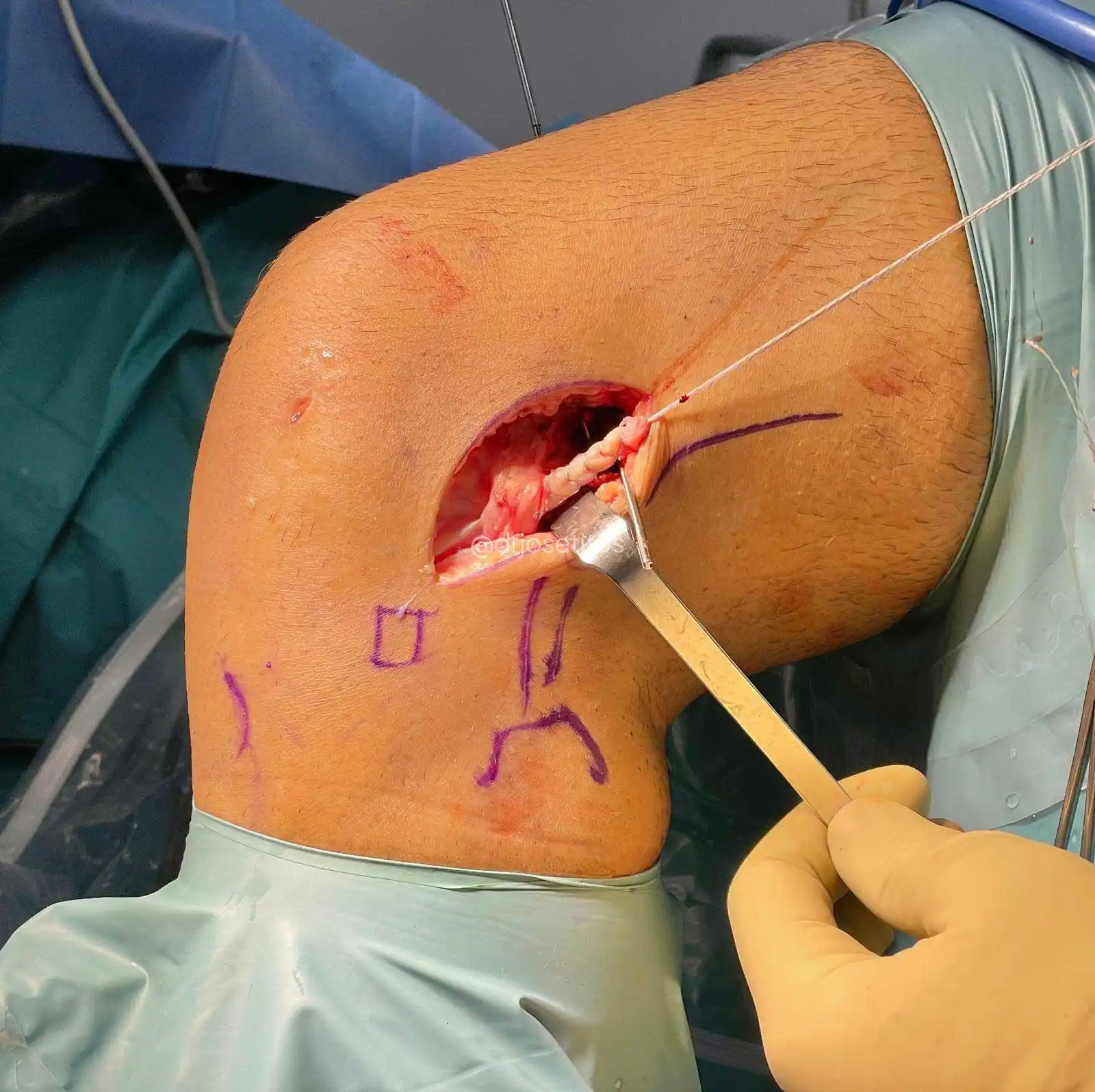Refuerzo-extra-articular Refuerzo-extra-articular