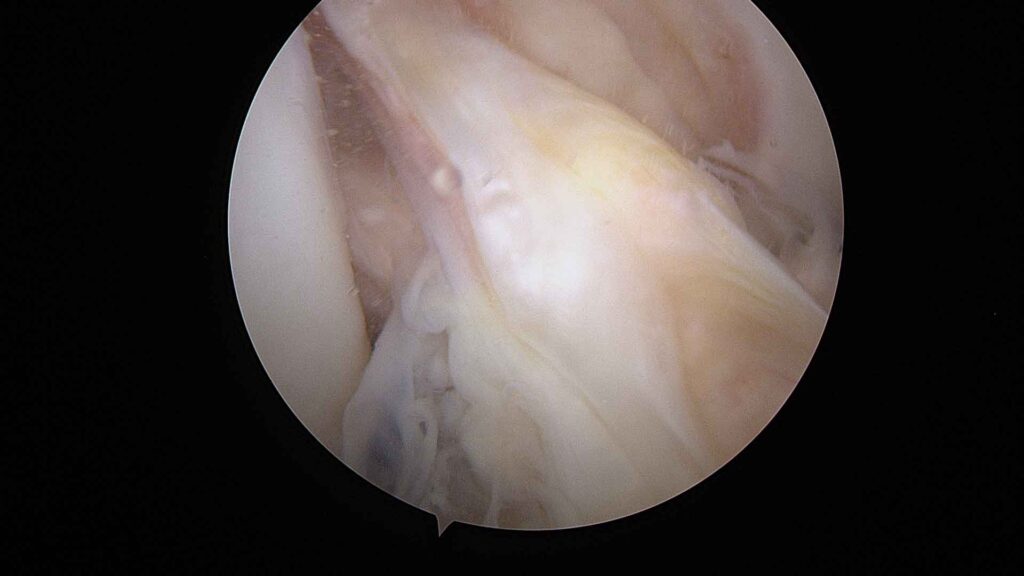 LCA desinsertado femoral