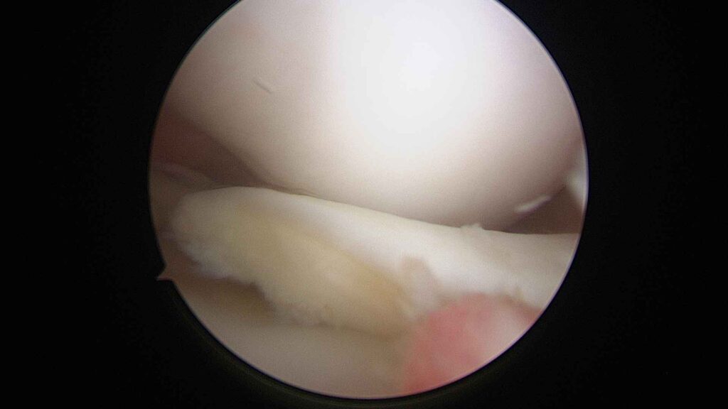 Fragmento Meniscal Libre