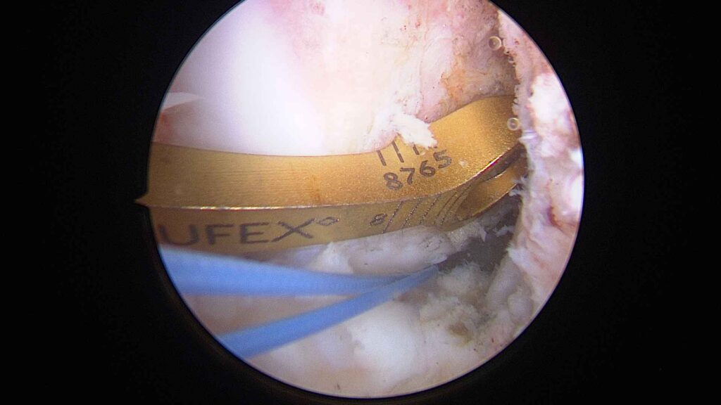 Guía femoral para reconstrucción LCA