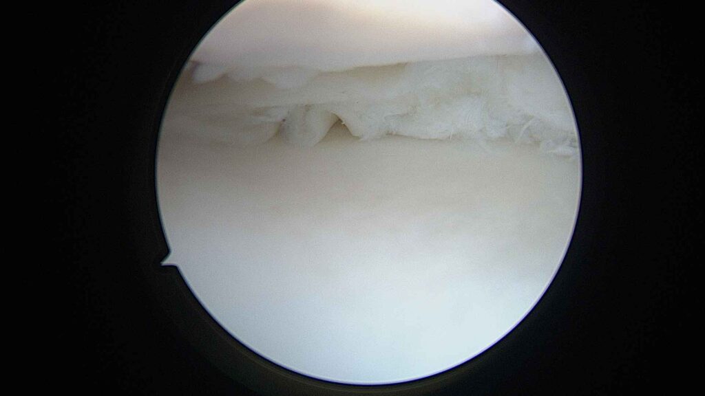 Rotura posterior menisco interno