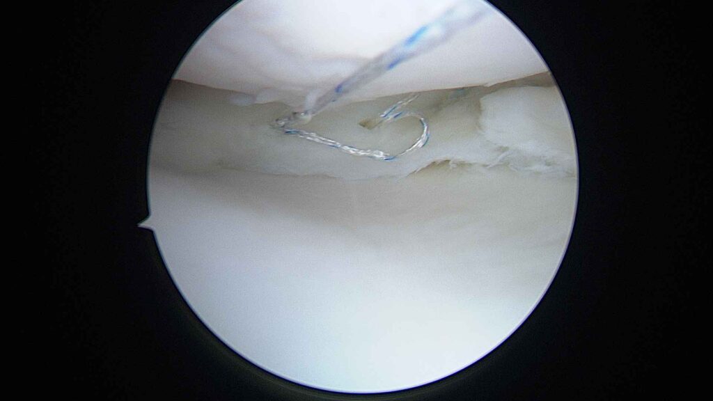 Sutura all inside menisco