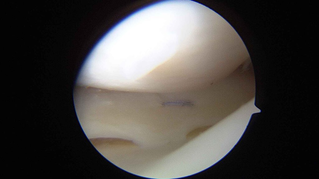Sutura meniscal